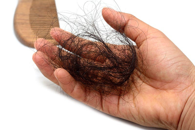 alopecia caída del pelo